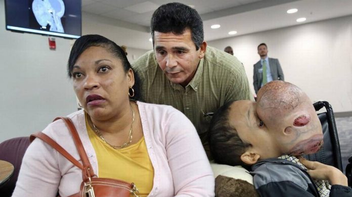 Emanuel Zayas Dies After Surgery to Remove 10-Pound Tumor From Face