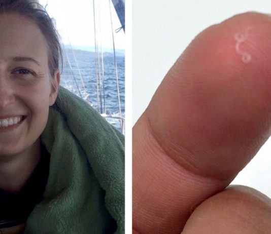 Researchers thrilled as woman finds 14 worms in her eye (Picture) Researchers thrilled as woman finds 14 worms in her eye