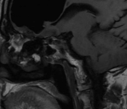 Doc find air pocket where part of man’s brain should be Doc find air pocket where part of man’s brain should be