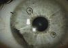 Rare Eye Cancer Ocular Melanoma Has Started to Appear in two States Rare Eye Cancer Ocular Melanoma Has Started to Appear in two States