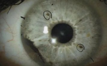 Rare Eye Cancer Ocular Melanoma Has Started to Appear in two States Rare Eye Cancer Ocular Melanoma Has Started to Appear in two States