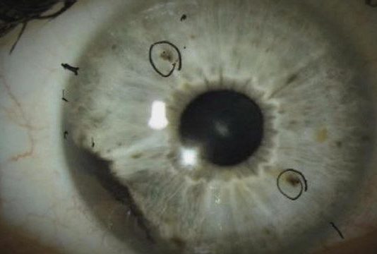 Rare Eye Cancer Ocular Melanoma Has Started to Appear in two States Rare Eye Cancer Ocular Melanoma Has Started to Appear in two States