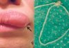 Moving lump on woman's face turns out to be worm (Picture)
