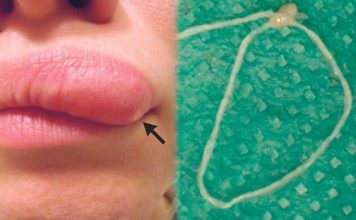 Moving lump on woman’s face turns out to be worm (Picture) Moving lump on woman's face turns out to be worm (Picture)