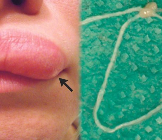 Moving lump on woman’s face turns out to be worm (Picture) Moving lump on woman's face turns out to be worm (Picture)