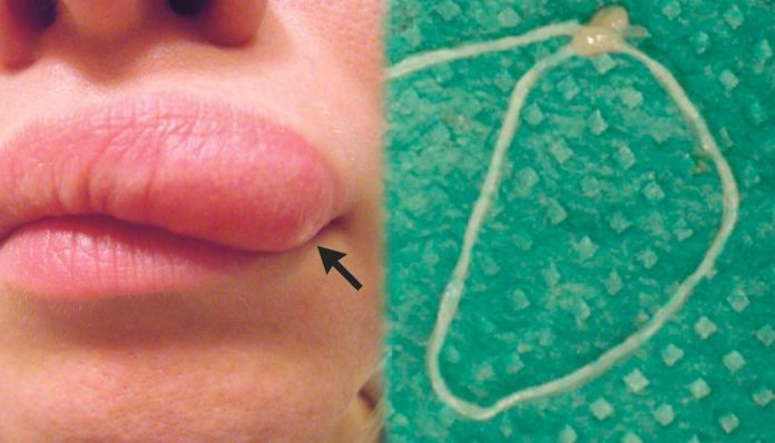 Moving lump on woman's face turns out to be worm (Picture)