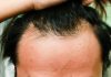 US Researchers Announce 'Critical Breakthrough' In Treatment For Baldness
