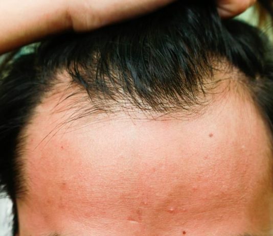 US Researchers Announce ‘Critical Breakthrough’ In Treatment For Baldness US Researchers Announce 'Critical Breakthrough' In Treatment For Baldness