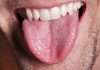 Losing tongue fat improves sleep apnea, According to Study