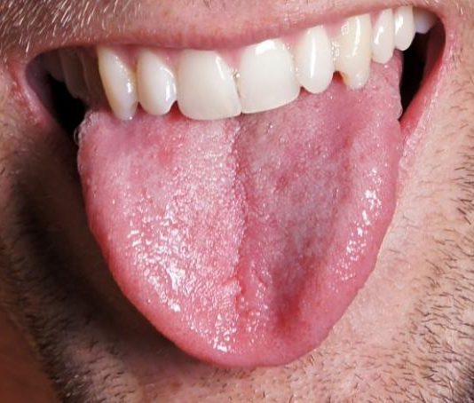Losing tongue fat improves sleep apnea, According to Study Losing tongue fat improves sleep apnea, According to Study