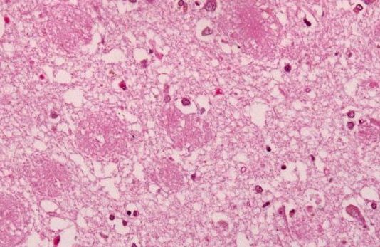 Drugs fail to slow decline in early onset Alzheimer’s disease Drugs fail to slow decline in early onset Alzheimer's disease