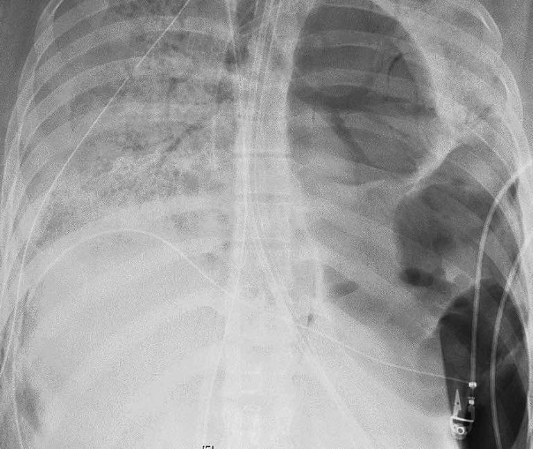 Woman’s lungs look like ‘Swiss cheese’ after COVID19, gets double