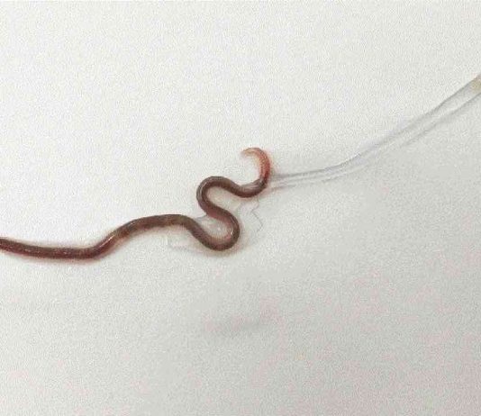 Doctors pull 1.5-inch worm from woman’s tonsils (Photo) Doctors pull 1.5-inch worm from woman's tonsils (Photo)