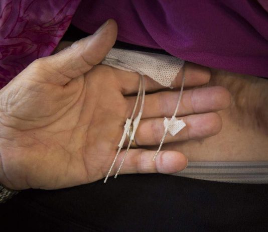 Spinal stimulators repurposed to restore touch in lost limb (Study) Spinal stimulators repurposed to restore touch in lost limb (Study)