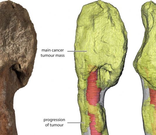 Researchers Identify Cancer in a Dinosaur Fossil for the First Time Researchers Identify Cancer in a Dinosaur Fossil for the First Time