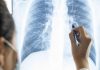 Post-COVID lungs worse than the worst smokers’ lungs, Study Finds